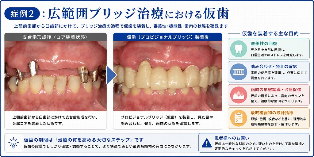 仮歯とは？治療中の歯を守り、理想の被せ物へ導く重要なステップ