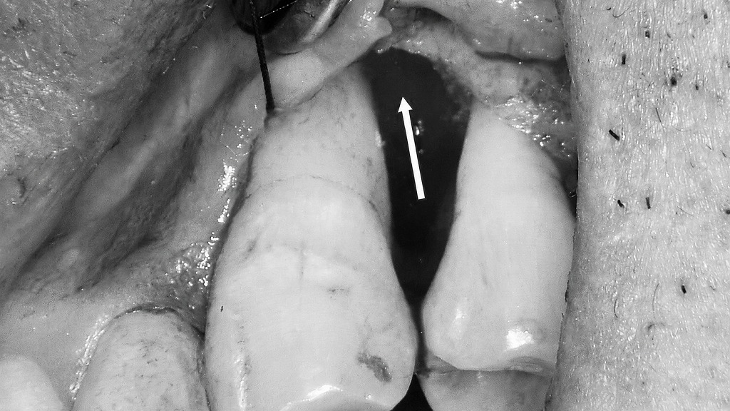 フラップ手術（歯肉剥離掻爬術）