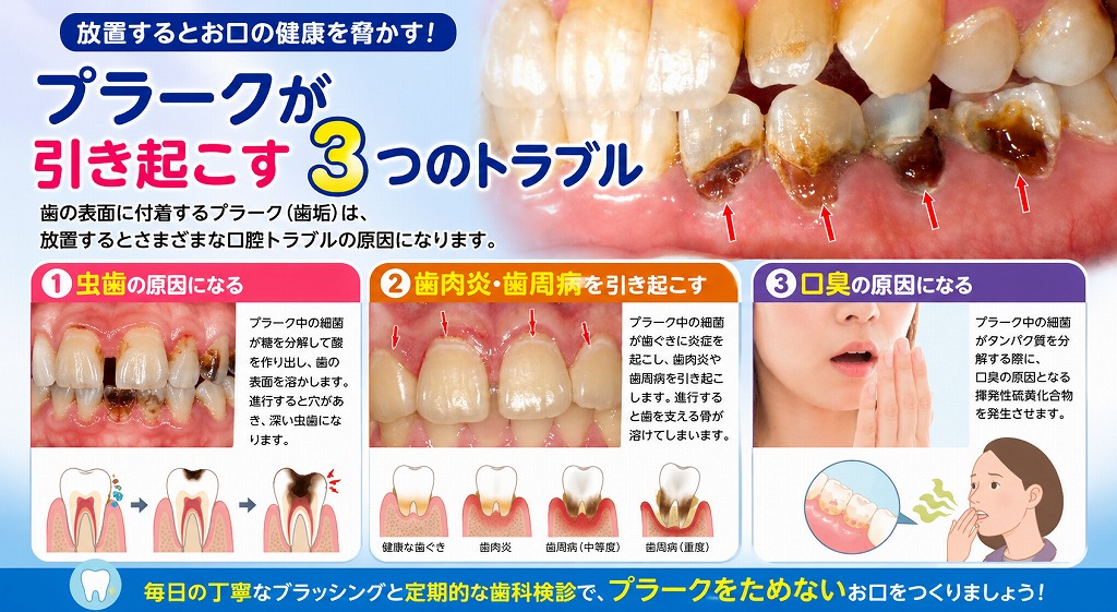 プラークが引き起こす3つのトラブル