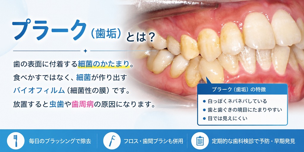 プラーク(歯垢)とは?