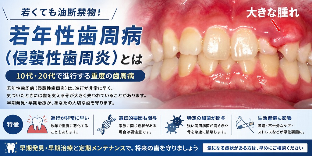 若年性歯周病（侵襲性歯周炎）とは？｜若い世代でも歯を失う危険がある