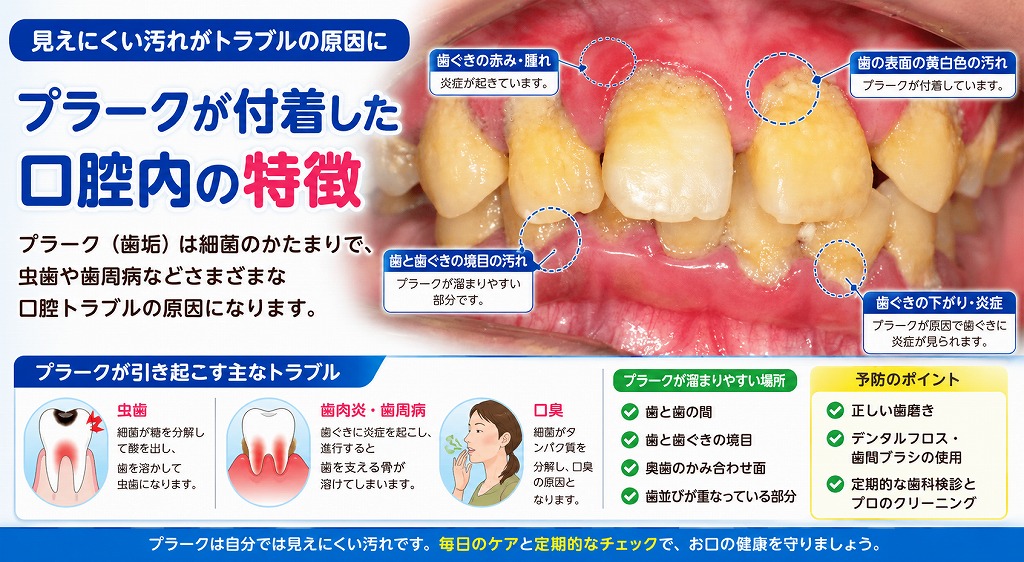 プラークが付着した口腔内の特徴