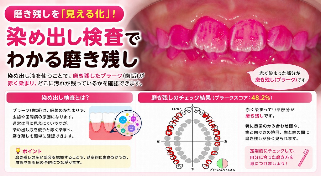 染め出し検査でわかる磨き残し