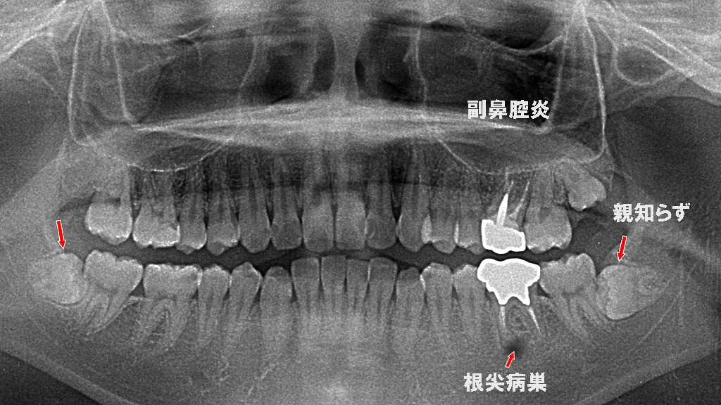気圧の変化で痛みが出やすい典型例：副鼻腔炎・親知らず・根尖病巣