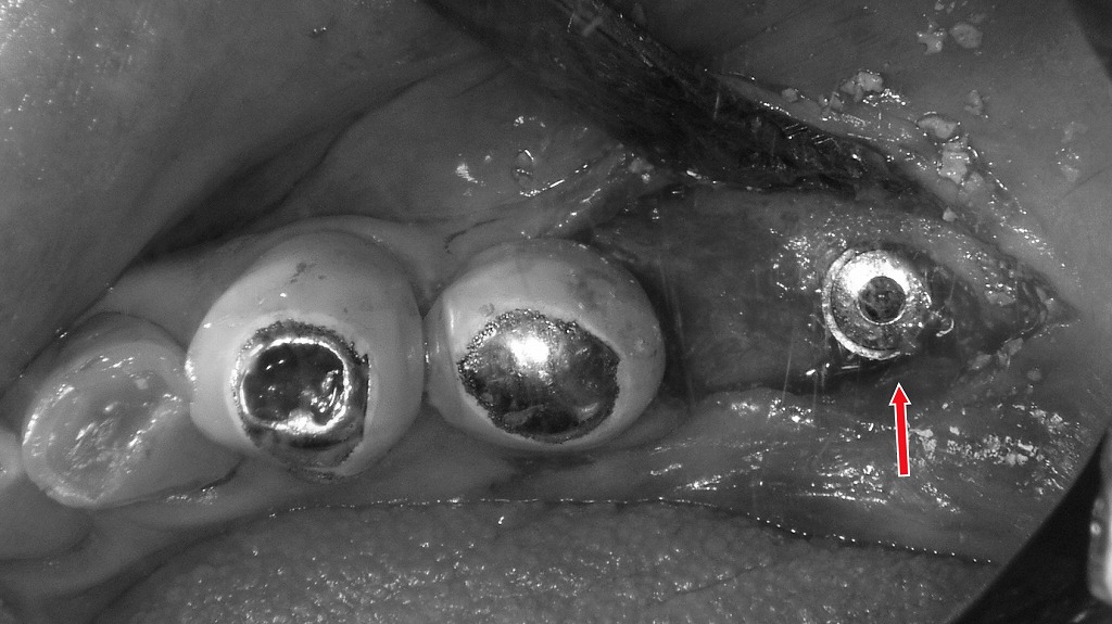 欠損した下顎臼歯部にインプラントを正確な位置へ埋入し、咬む力を回復する準備が整った状態。