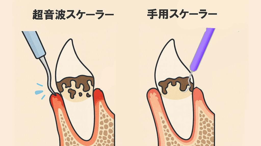 超音波スケーラーと手用スケーラーの比較
