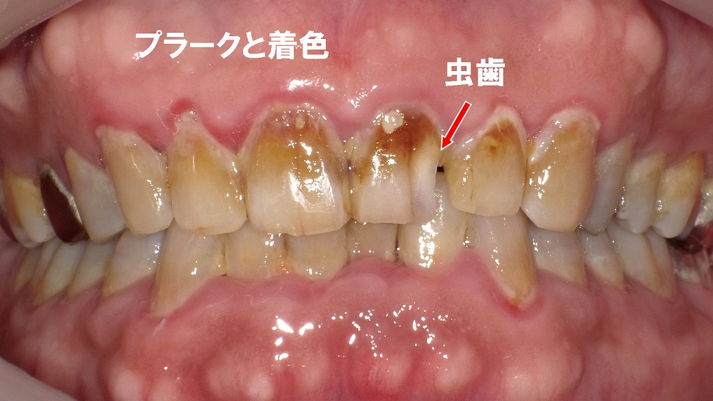 ザラザラ感の原因は「C2虫歯」と「プラーク（汚れ）・着色」