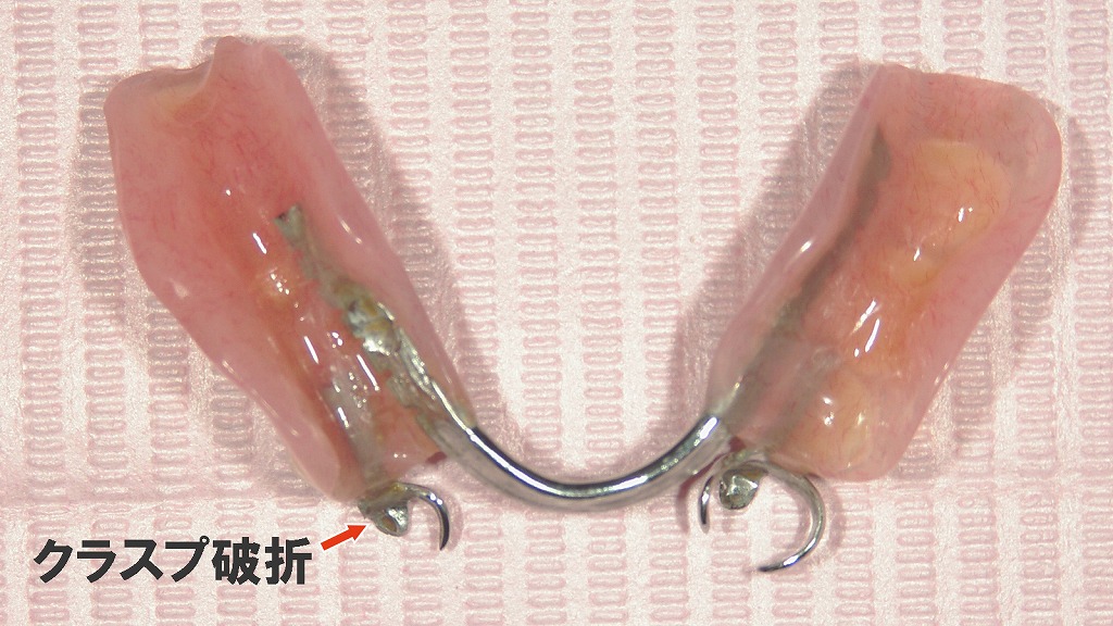 保険適用義歯のクラスプが破折