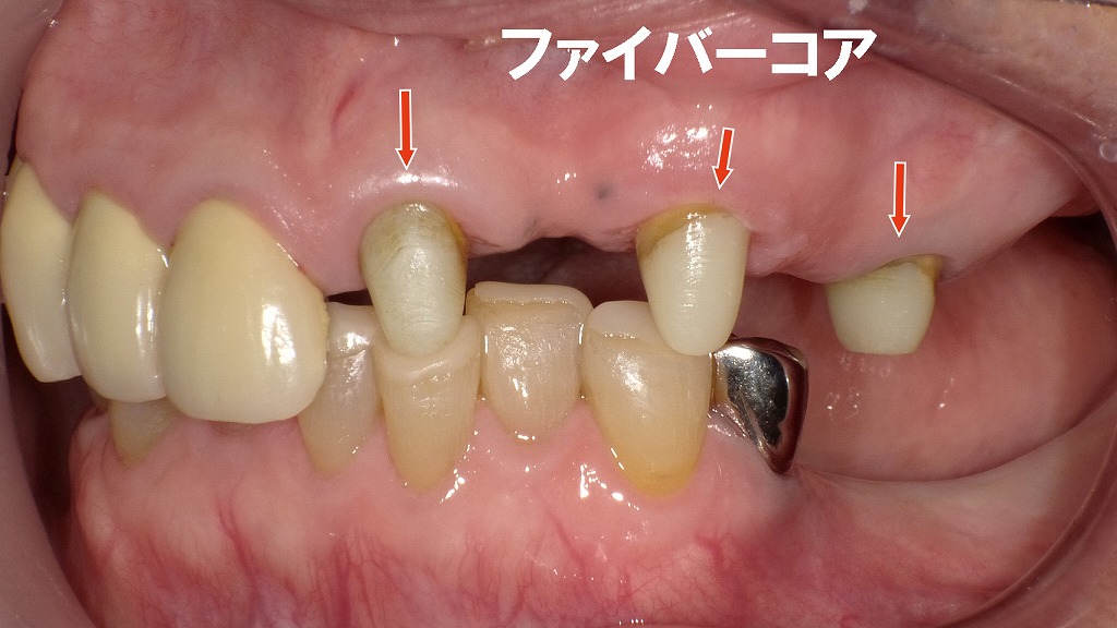 ファイバーコア（白い支台）