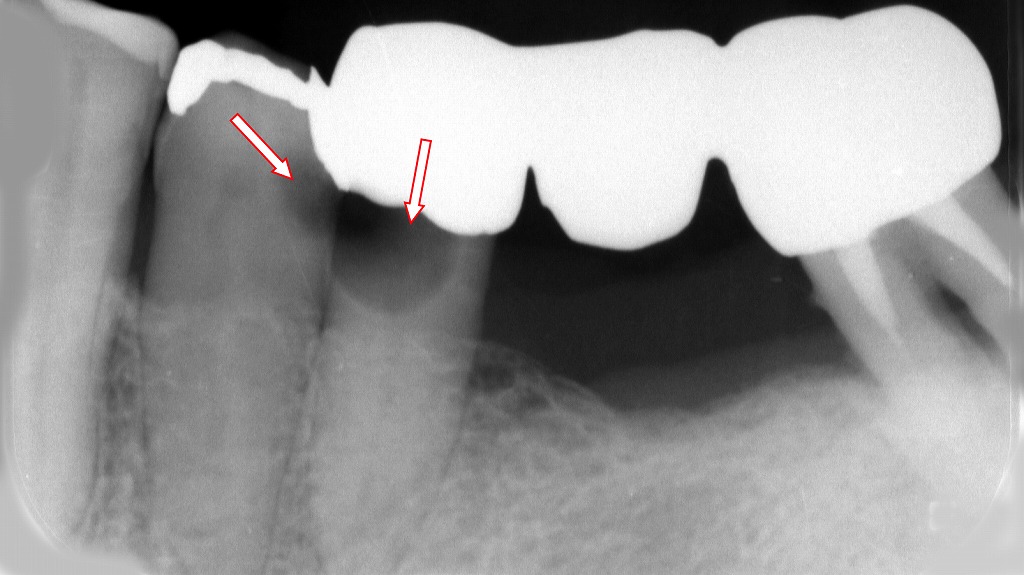 症例3：ブリッッジ内部と詰め物の下に虫歯