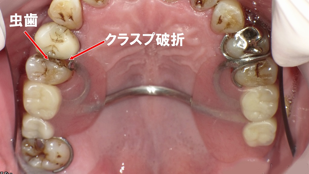 保険の部分入れ歯が安定しない原因：クラスプ破折と支台歯の虫歯