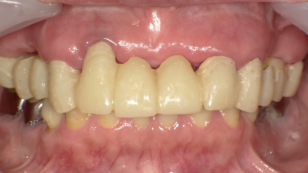 ブリッジの仮歯装着