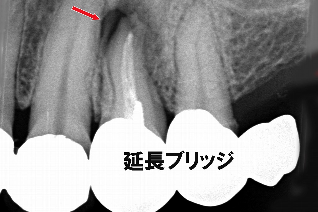 神経を抜いた歯が痛むのはなぜ？延長ブリッジが抱える負担のリスク