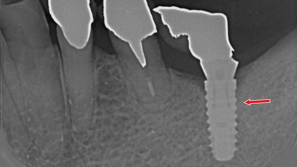 インプラントと骨の結合が良好で、上部構造が装着された完成状態。