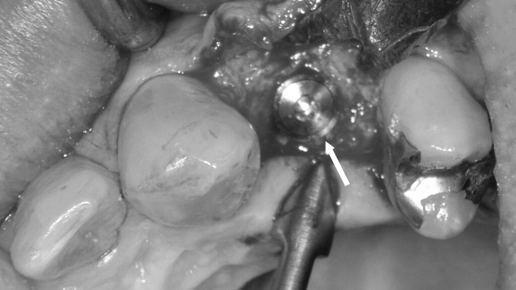 第一小臼歯欠損部にインプラント埋入