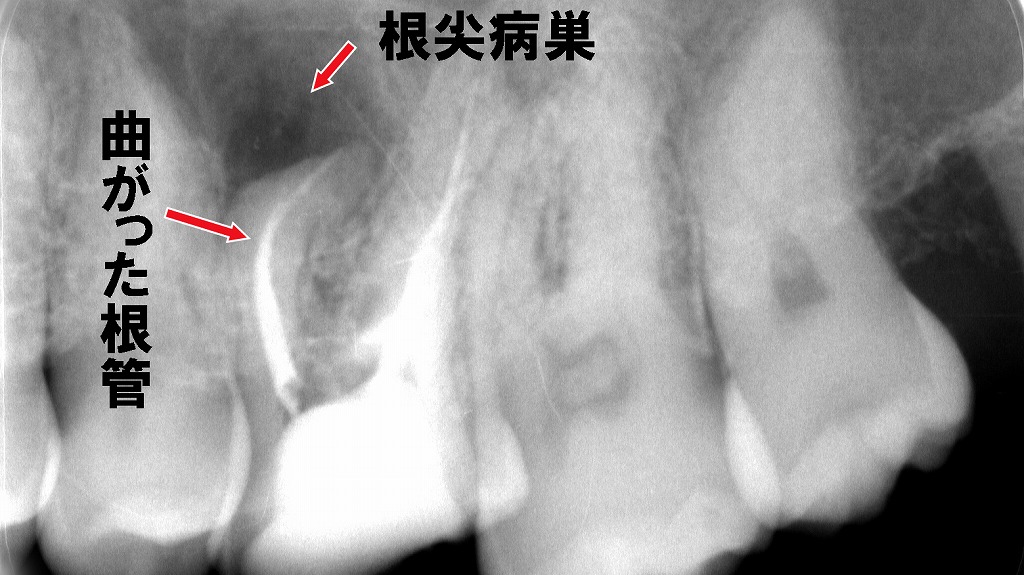 奥歯の根管治療が難しい理由：複雑に分岐する細く曲がった根管