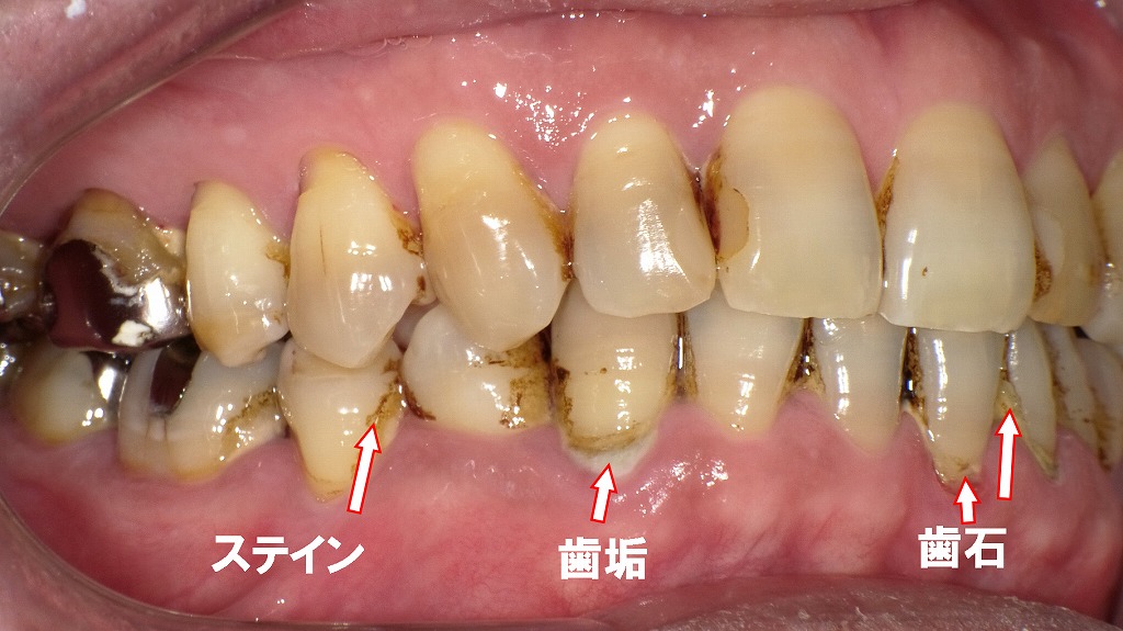 術前:歯周病に罹患している症例