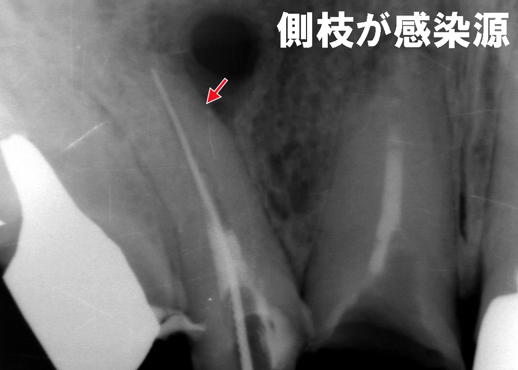側枝感染が治癒を妨げる理由｜根管治療が難しくなる見えない通路
