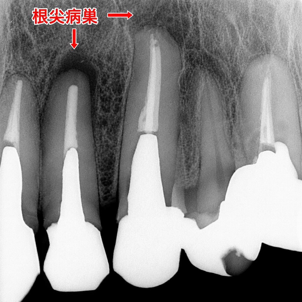 根管治療が失敗した症例