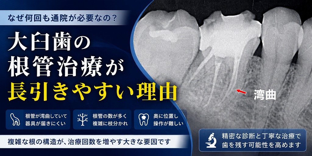 大臼歯の根管治療が長引きやすい理由