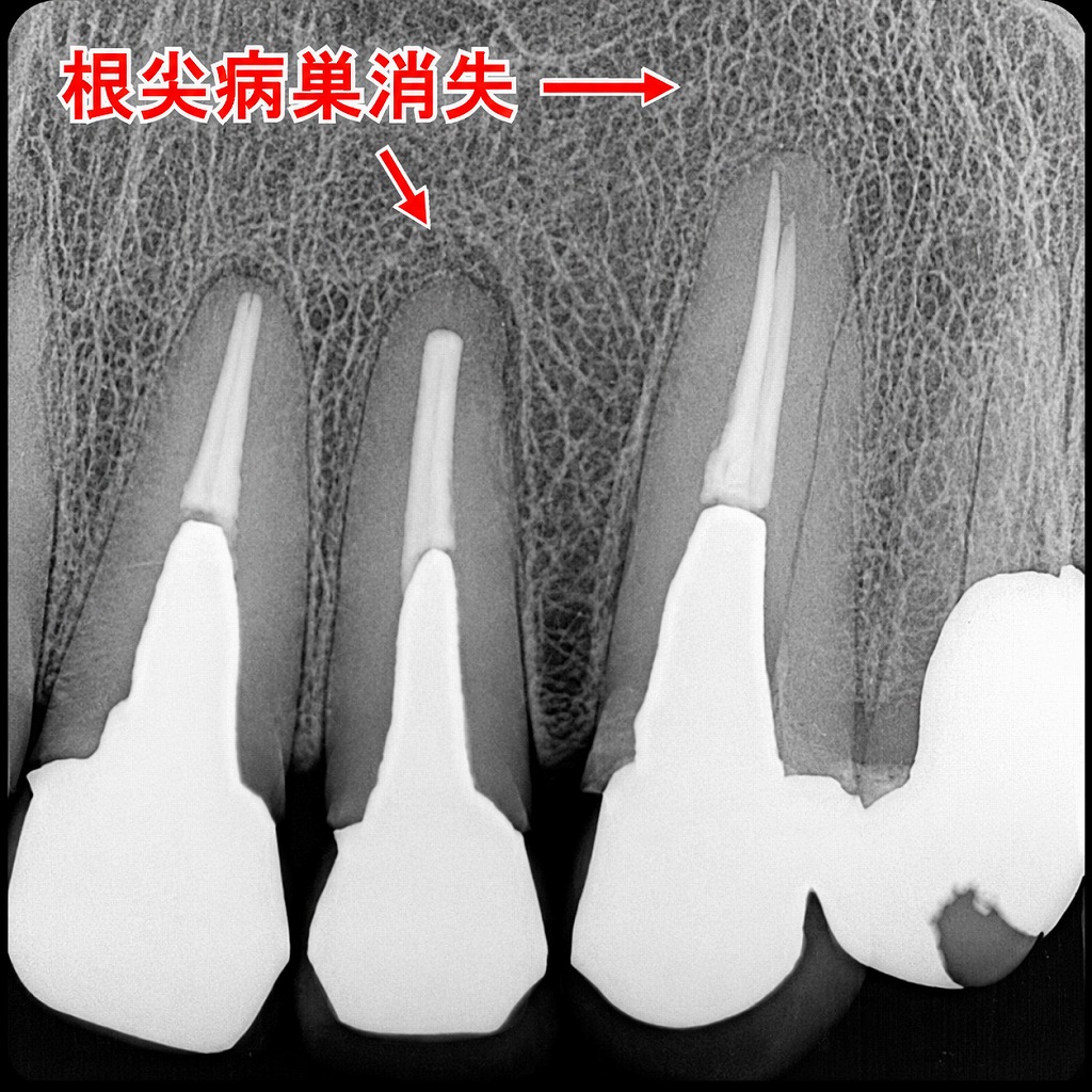再根管治療後に根尖病巣が治癒