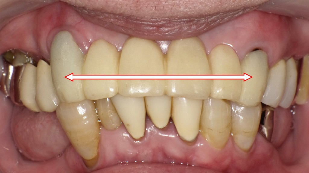 正面観：ブリッジ形態の仮歯