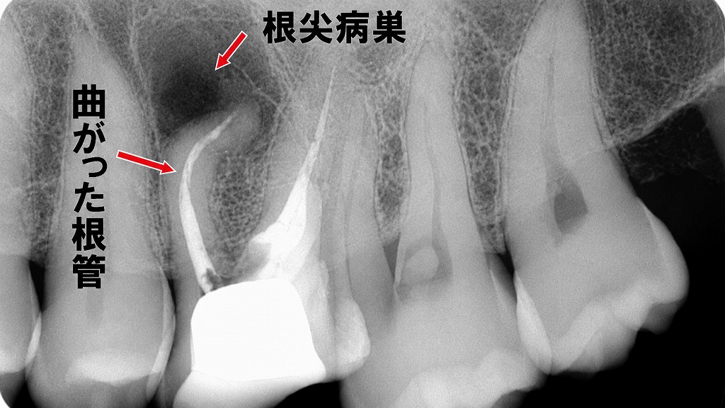 根管治療の失敗症例：奥歯の根管治療が難しい理由は複雑に分岐する細く曲がった根管があるため