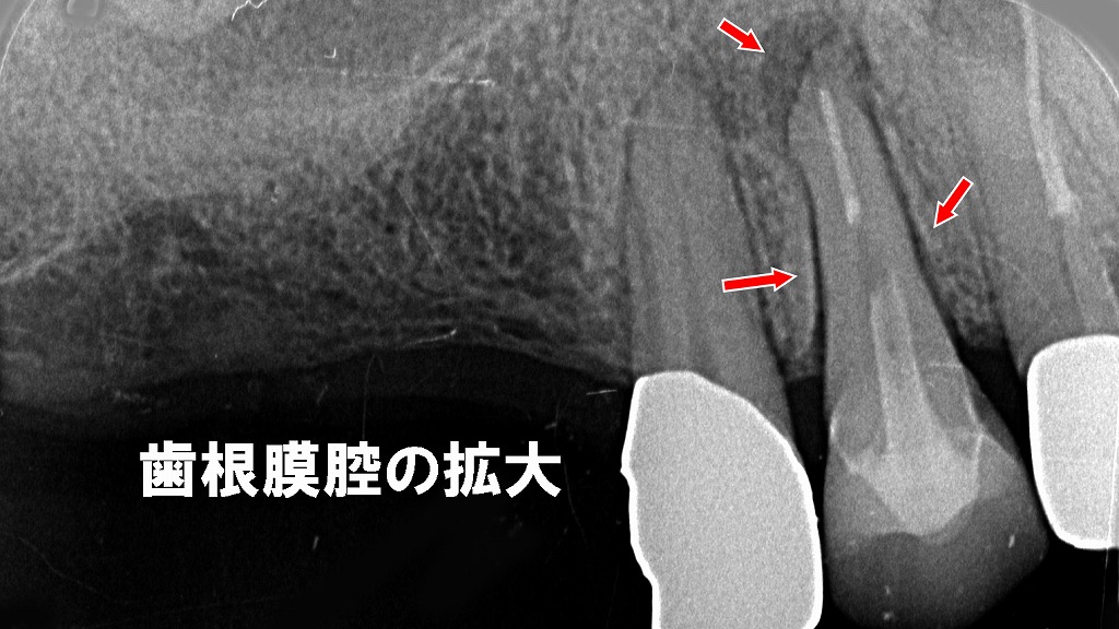 赤矢印部に歯根膜腔の明らかな拡大を認め、咬合性外傷および歯根膜炎が疑われる所見。大臼歯欠損により負担が前方歯に集中し、根尖部には透過像を認め根尖病巣が示唆される。