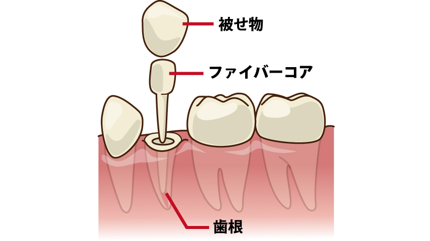差し歯とは？