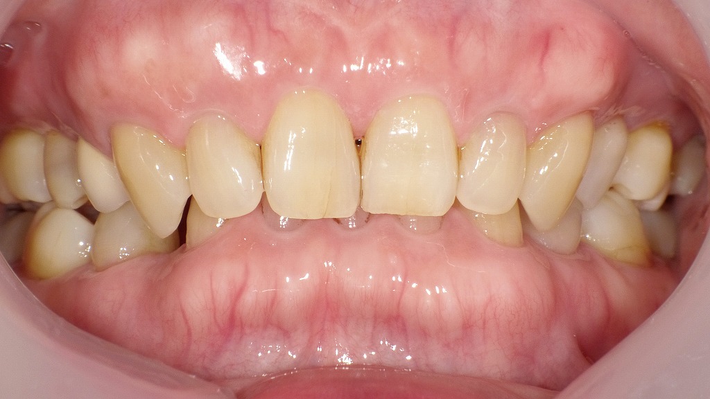 症例2：大人（永久歯）の過蓋咬合