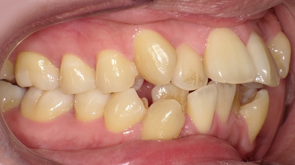 叢生（ガタガタの歯並び）の症例