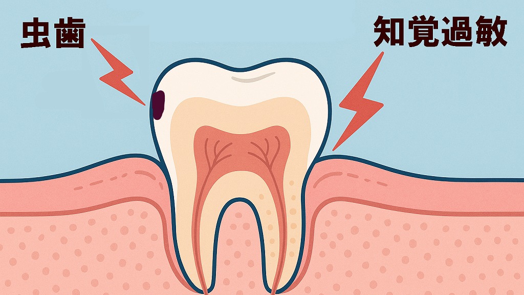 甘いものを食べると歯にしみる原因