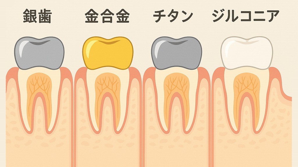 主な歯科用金属の種類と特徴