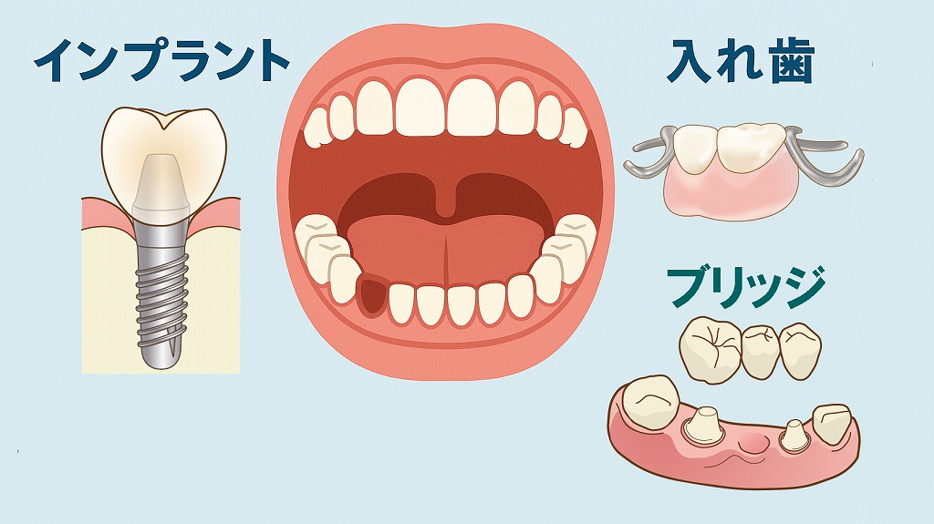 歯がない場合の治療法