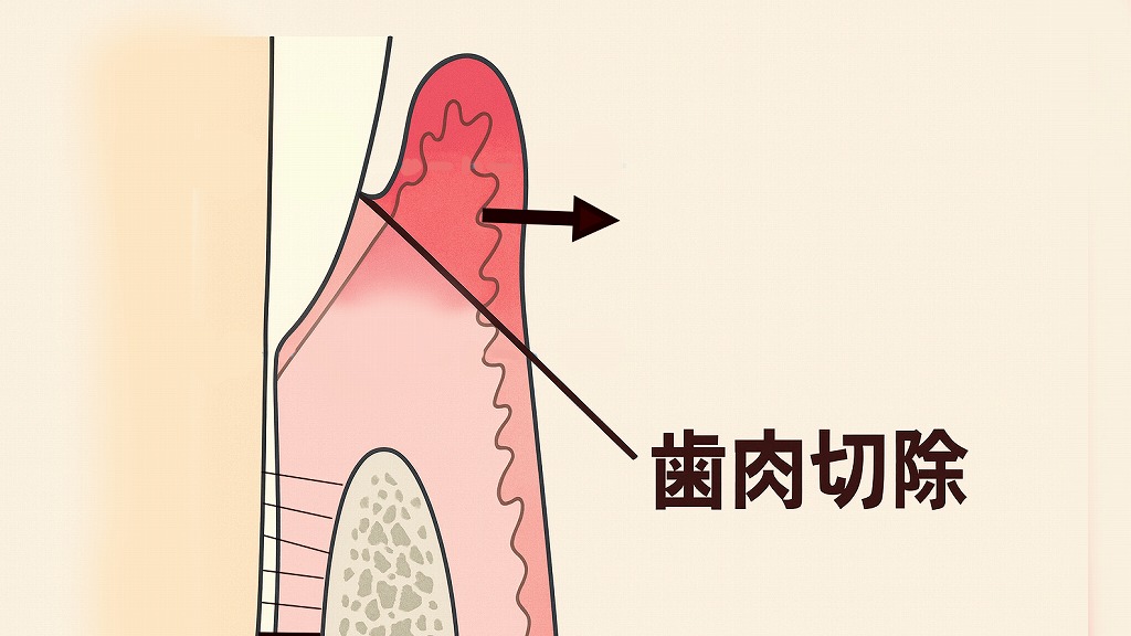 歯肉切除術