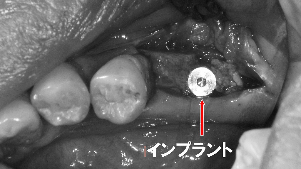 インプラントは歯を失った後の回復手段。8020達成には、残っている歯のケアが最も大切です。