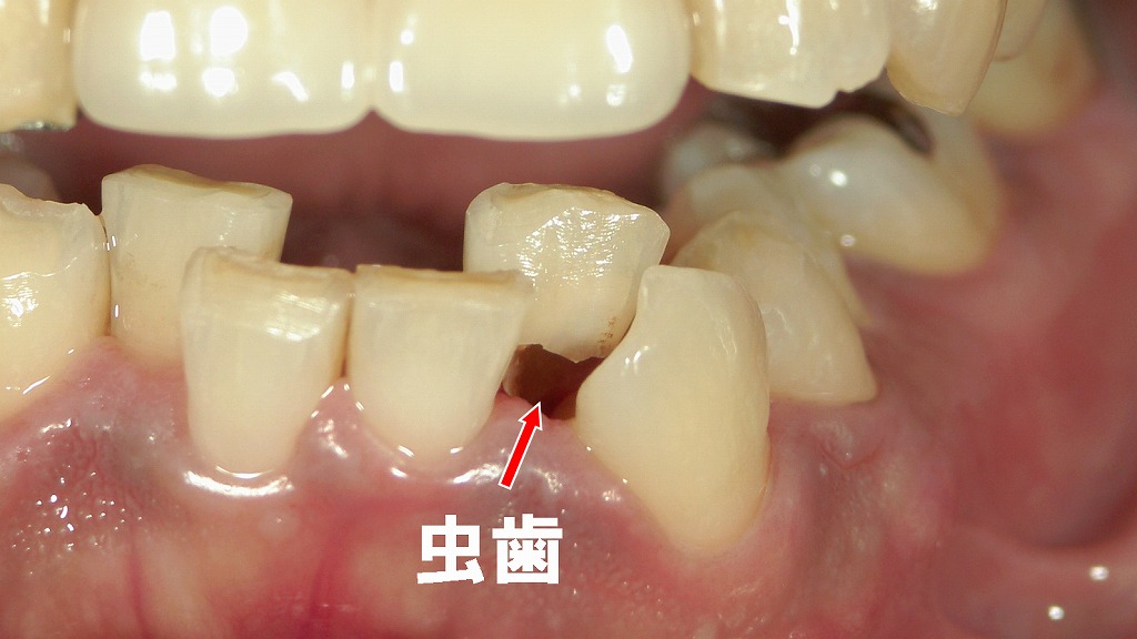歯並びの乱れにより清掃が難しく、隠れた部分に虫歯が進行した症例