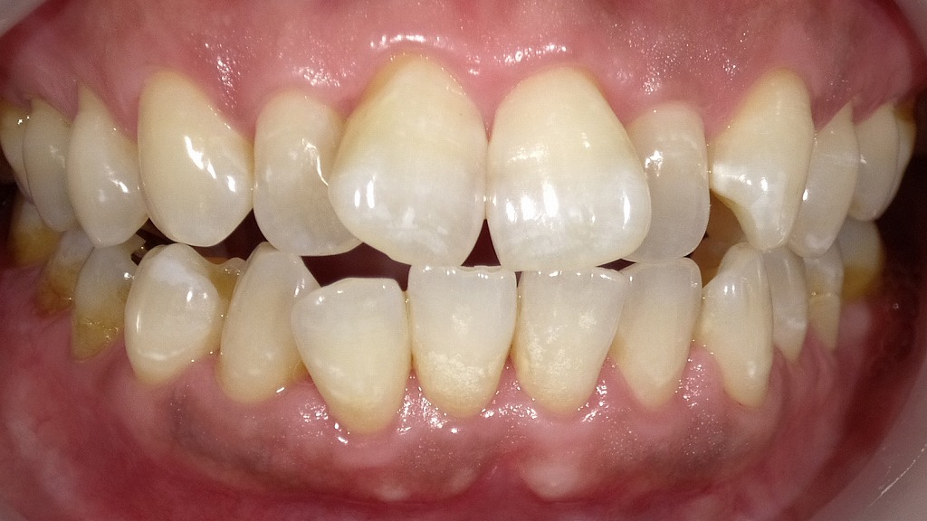 2枚目：ホワイトニング後