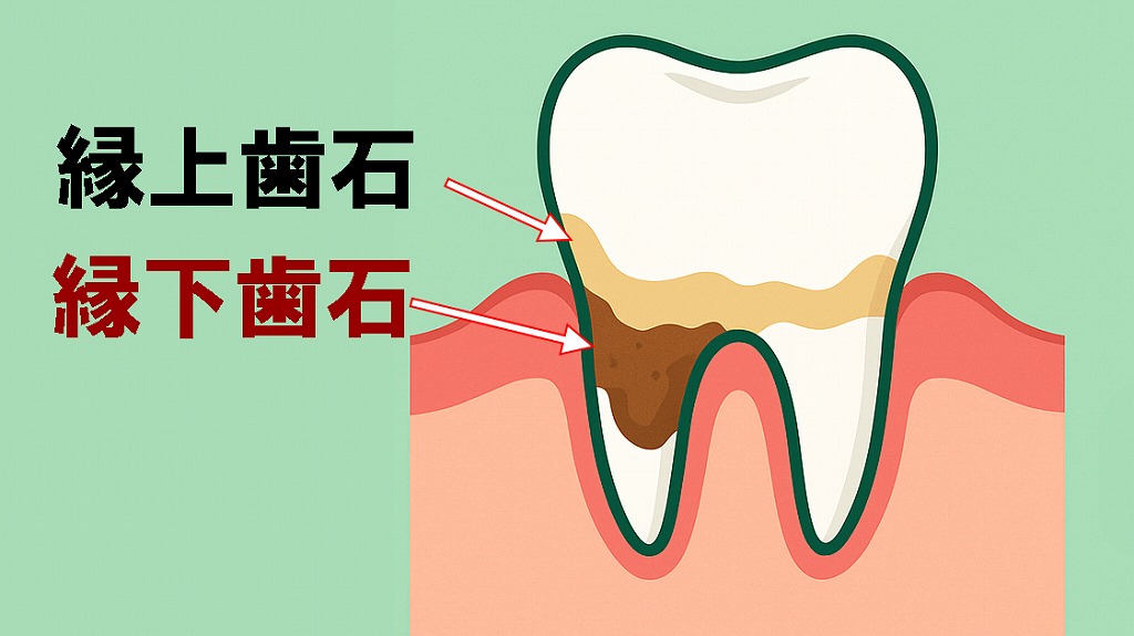 縁下歯石と縁上歯石