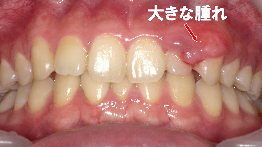 歯ぐき全体の強い炎症と大きな腫れが確認できる状態