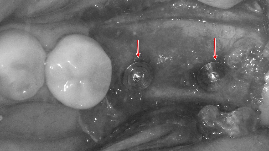 下顎６番７番相当部にインプラント埋入