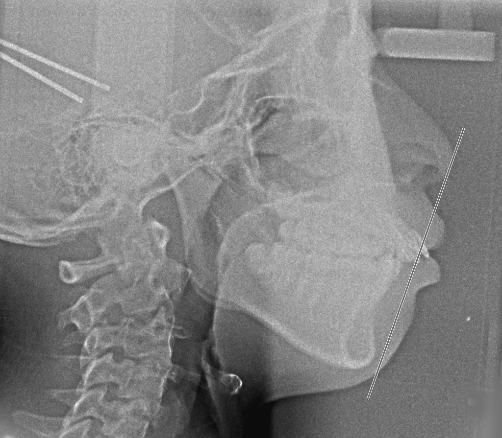 口ゴボのセファロレントゲン