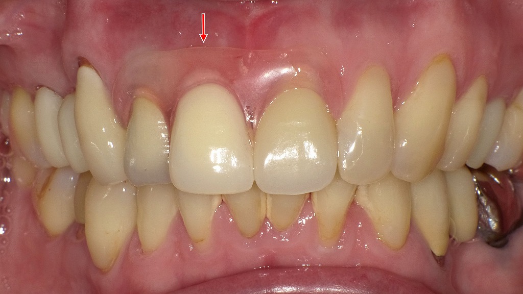 ノンクラスプデンチャー（スマイルデンチャー）装着後の自然な口元