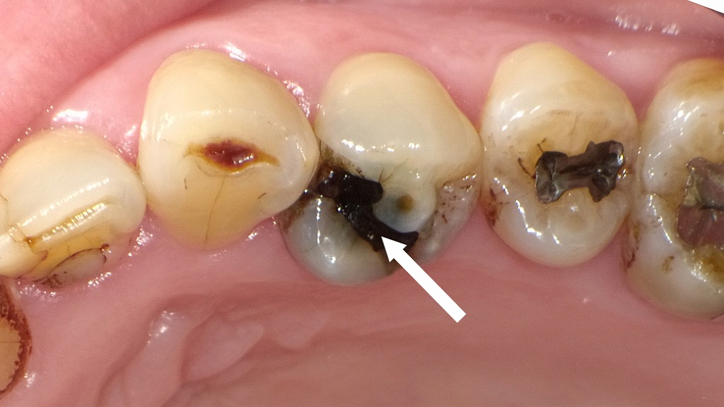 アマルガム合金