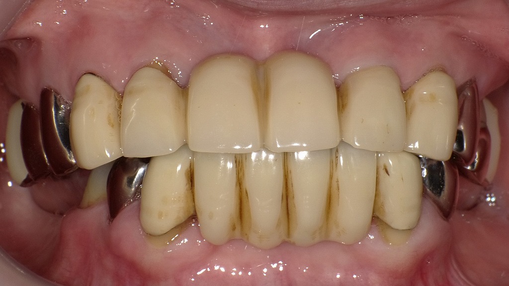 保険の前装冠が変色？見た目の悩みが増える理由とは