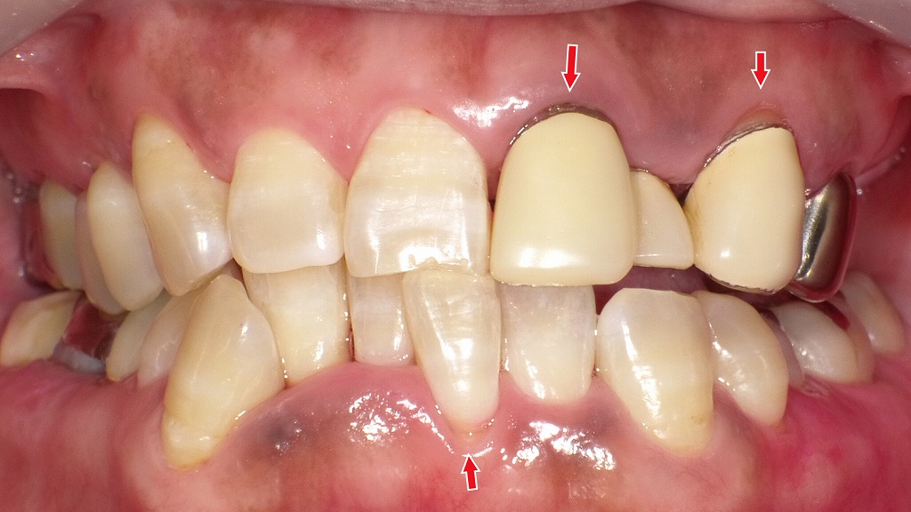術後：正しい歯磨きで歯ぐきの炎症が改善