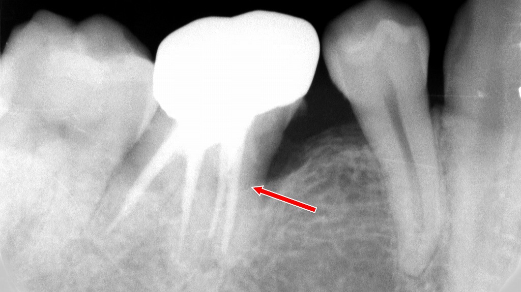 奥歯の根管治療が難しい理由｜複雑な根の形が治癒を妨げることも
