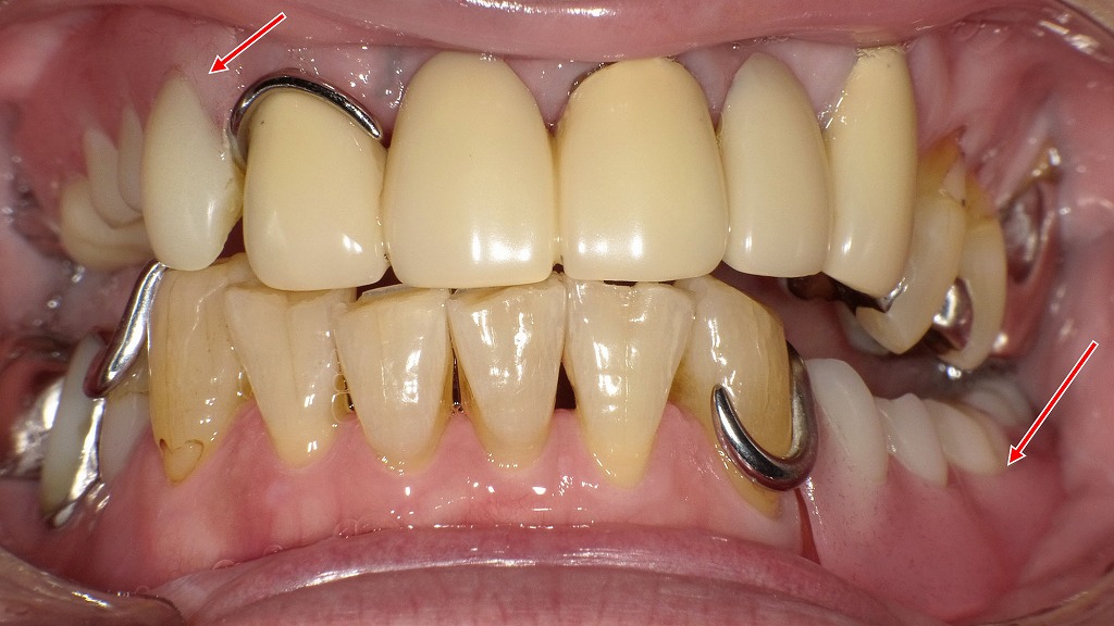 嚥下機能を支える入れ歯調整 ― 上下に保険のクラスプ義歯が入った症例