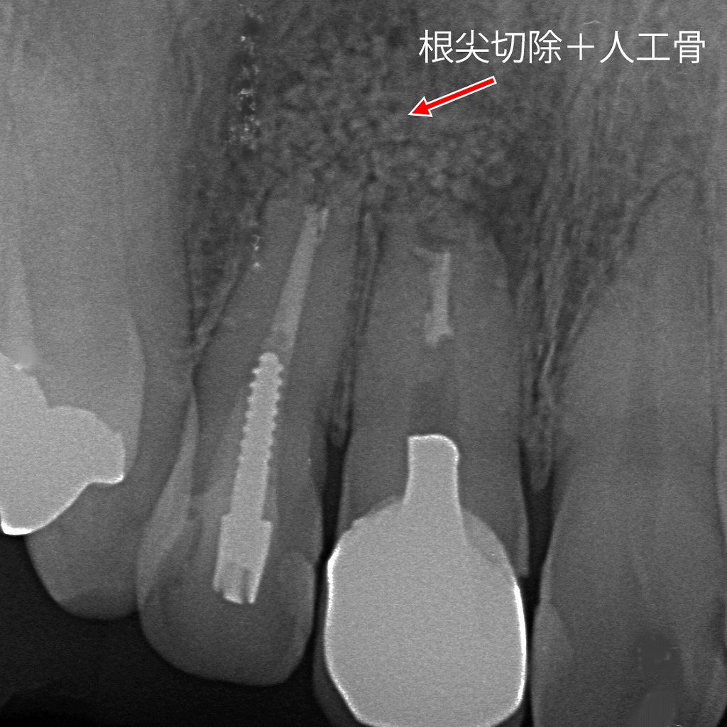 歯根端切除術＋人工骨による病変治療