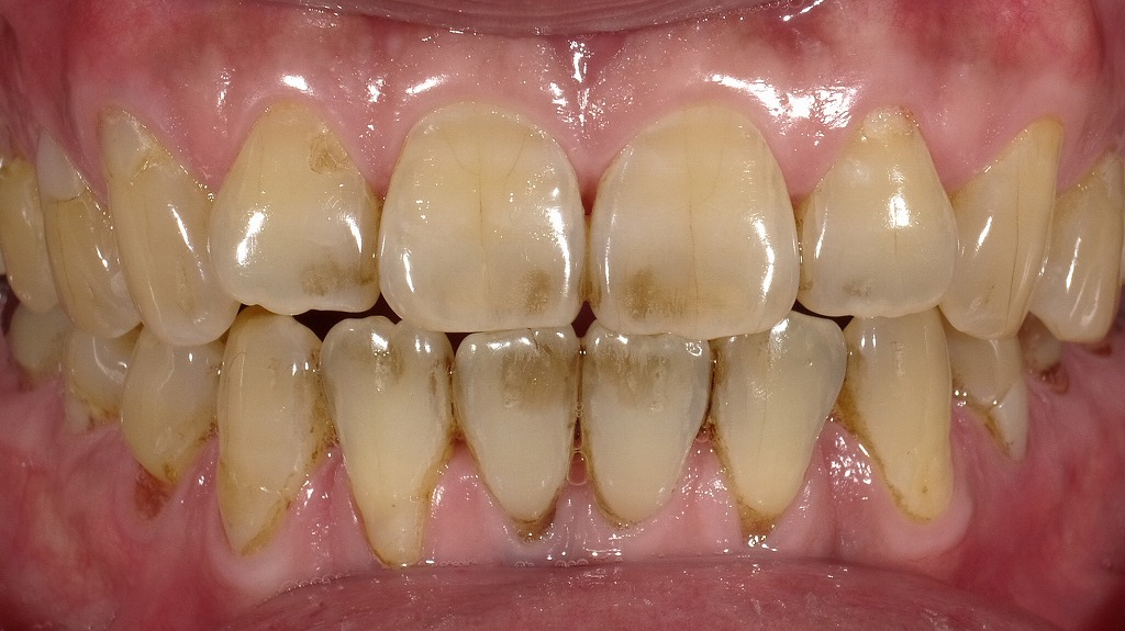 歯が黄色い症例
